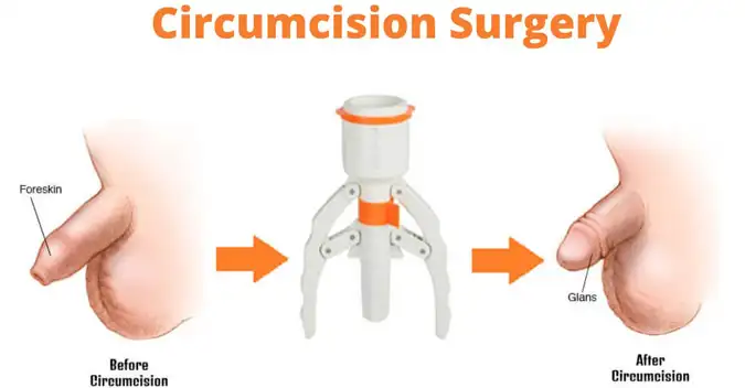 Blog post image for Circumcision Procedure