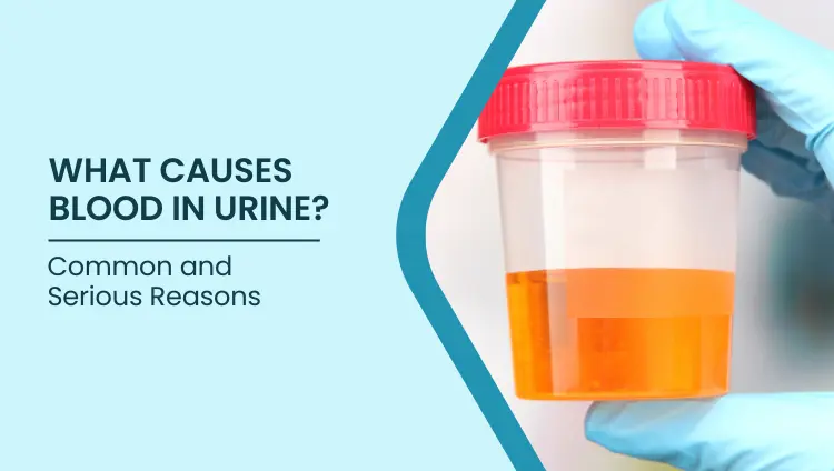 Blog post image for What Causes Blood in Urine? Common and Serious Reasons