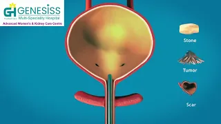 Cystoscopy procedure explained by expert urologist